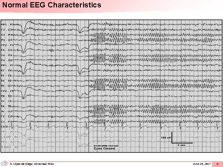 Normal EEG Characteristics S. López de Diego: Abnormal EEGs June 29, 2017 8 