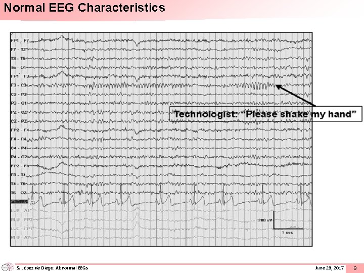 Normal EEG Characteristics S. López de Diego: Abnormal EEGs June 29, 2017 9 