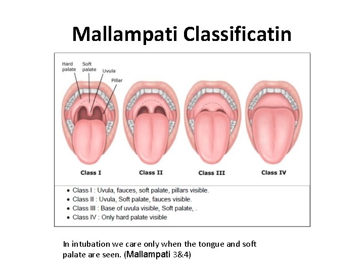 Mallampati Classificatin In intubation we care only when the tongue and soft palate are