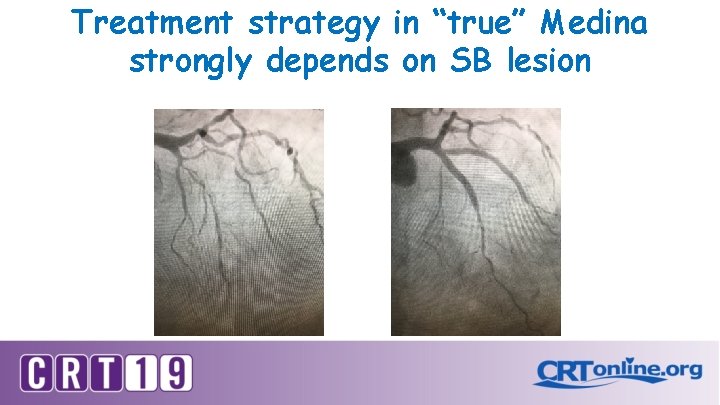 Treatment strategy in “true” Medina strongly depends on SB lesion 