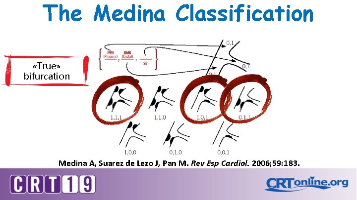 The Medina Classification «True» bifurcation Medina A, Suarez de Lezo J, Pan M. Rev