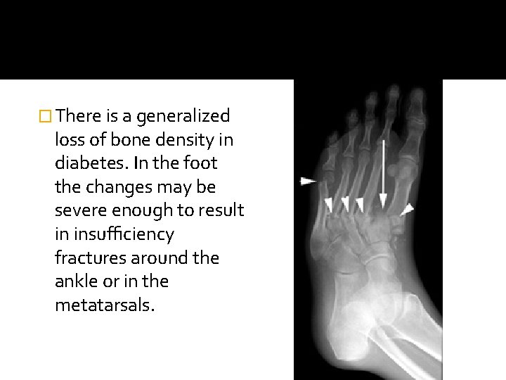 � There is a generalized loss of bone density in diabetes. In the foot