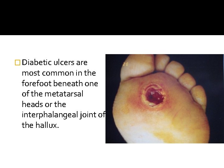 � Diabetic ulcers are most common in the forefoot beneath one of the metatarsal