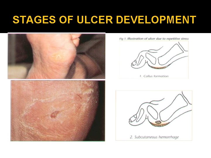 STAGES OF ULCER DEVELOPMENT 