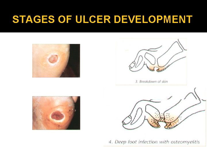 STAGES OF ULCER DEVELOPMENT 