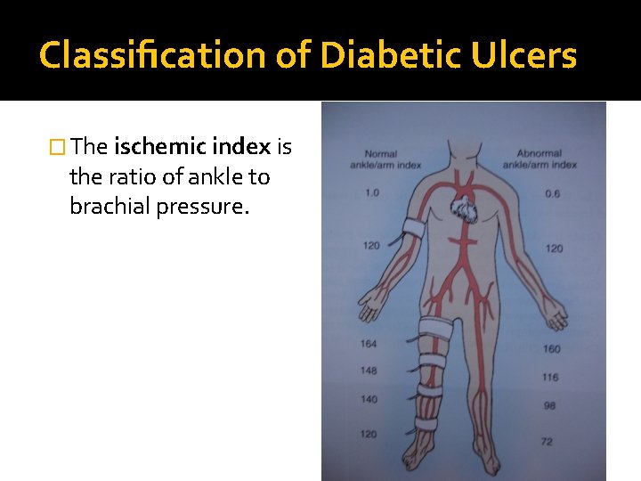 Classiﬁcation of Diabetic Ulcers � The ischemic index is the ratio of ankle to