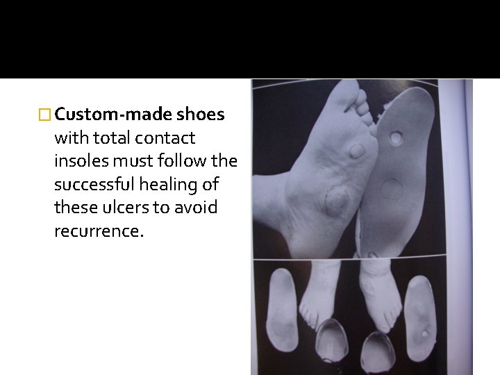 � Custom-made shoes with total contact insoles must follow the successful healing of these