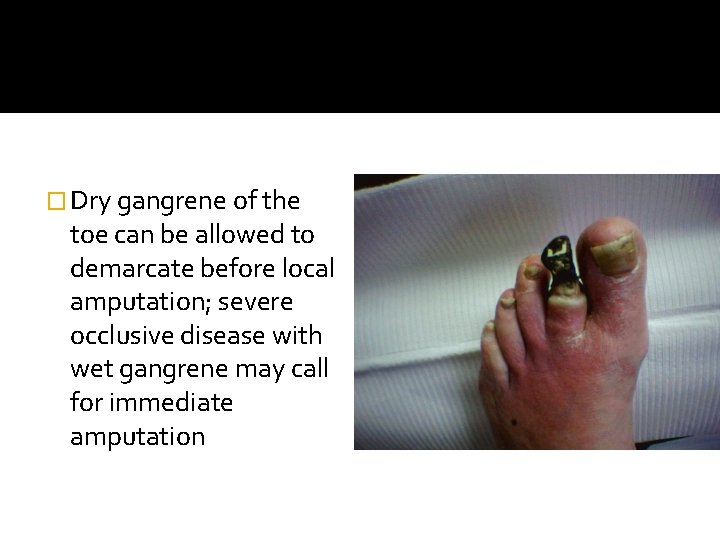 � Dry gangrene of the toe can be allowed to demarcate before local amputation;