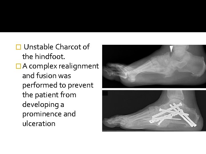 Unstable Charcot of the hindfoot. � A complex realignment and fusion was performed to