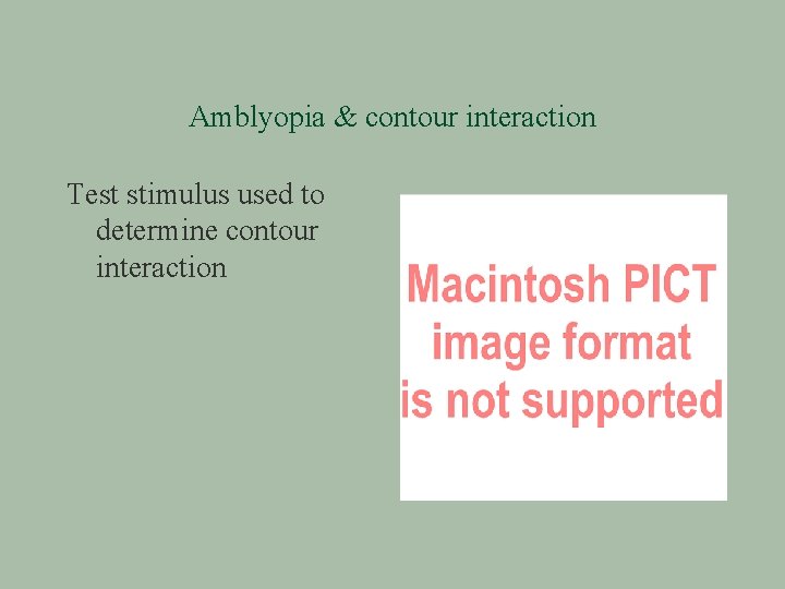 Amblyopia & contour interaction Test stimulus used to determine contour interaction 