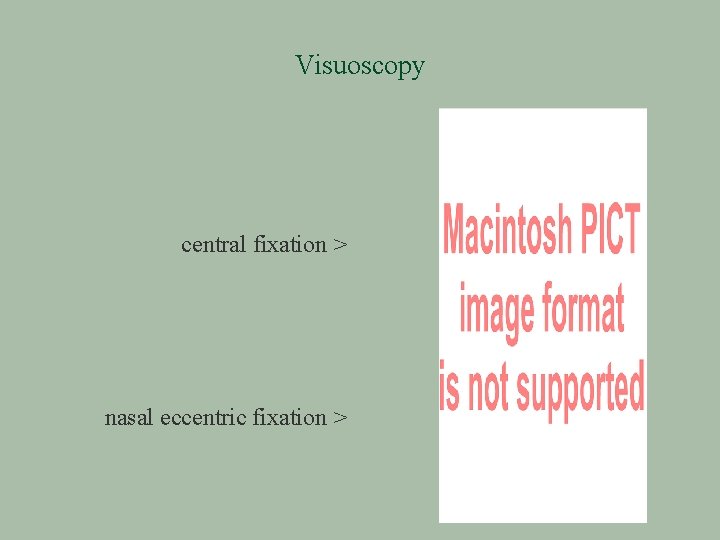 Visuoscopy central fixation > nasal eccentric fixation > 