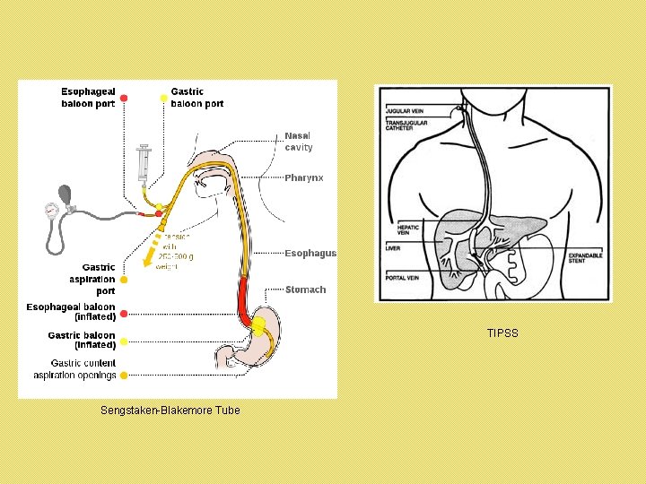 TIPSS Sengstaken-Blakemore Tube 