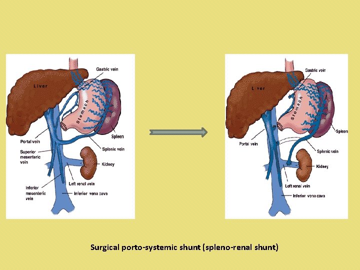Surgical porto-systemic shunt (spleno-renal shunt) 
