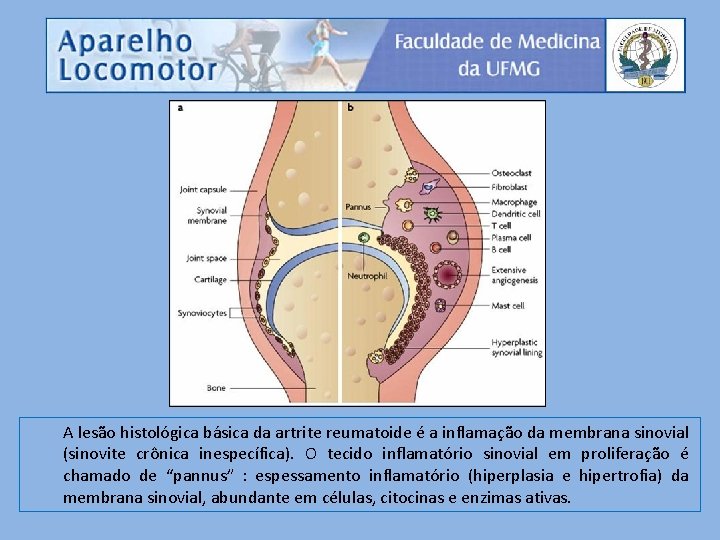 A lesão histológica básica da artrite reumatoide é a inflamação da membrana sinovial (sinovite