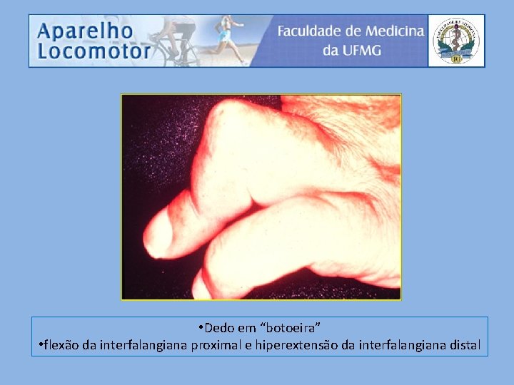  • Dedo em “botoeira” • flexão da interfalangiana proximal e hiperextensão da interfalangiana