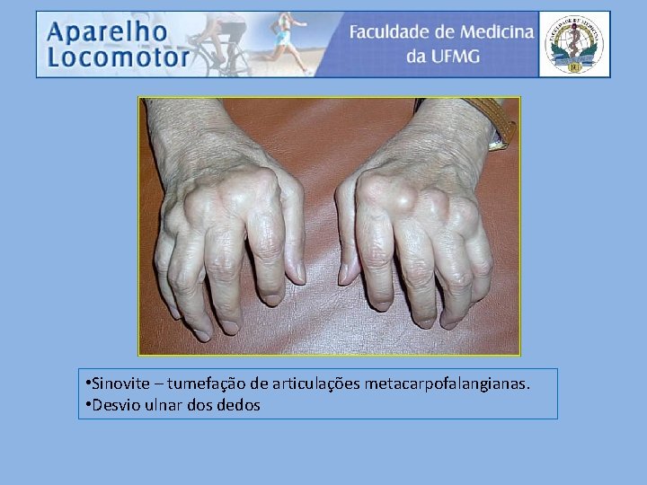  • Sinovite – tumefação de articulações metacarpofalangianas. • Desvio ulnar dos dedos 