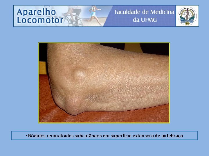  • Nódulos reumatoides subcutâneos em superfície extensora de antebraço 