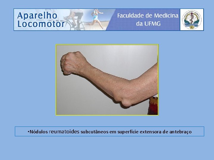  • Nódulos reumatoides subcutâneos em superfície extensora de antebraço 