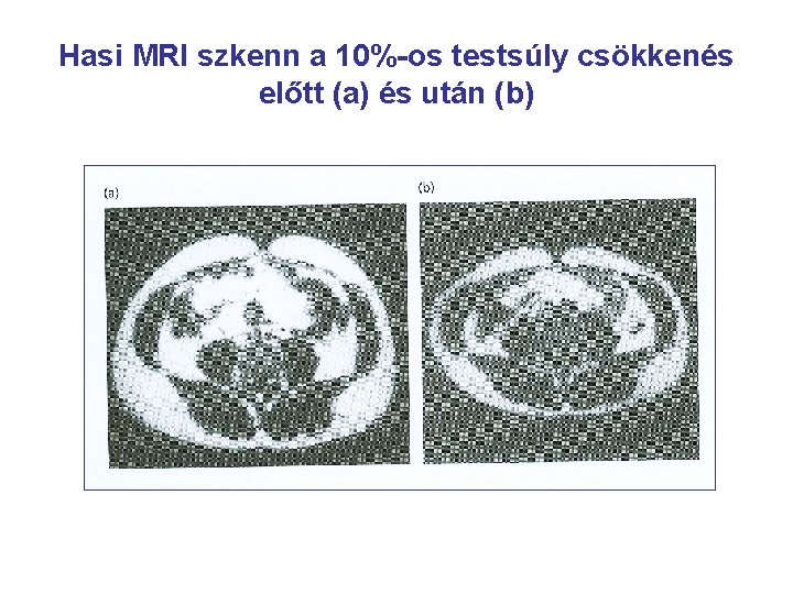 Hasi MRI szkenn a 10%-os testsúly csökkenés előtt (a) és után (b) 