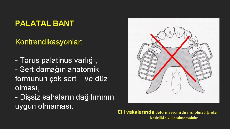 PALATAL BANT Kontrendikasyonlar: - Torus palatinus varlığı, - Sert damağın anatomik formunun çok sert