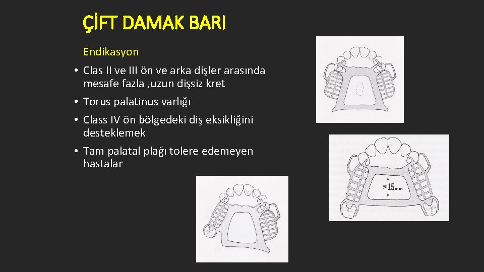 ÇİFT DAMAK BARI Endikasyon • Clas II ve III ön ve arka dişler arasında