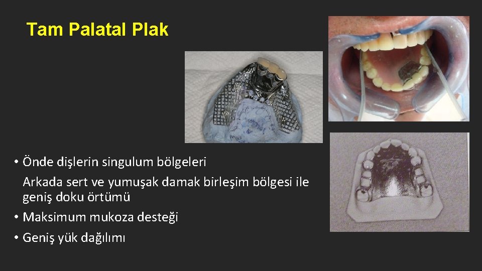 Tam Palatal Plak • Önde dişlerin singulum bölgeleri Arkada sert ve yumuşak damak birleşim