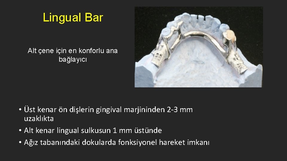 Lingual Bar Alt çene için en konforlu ana bağlayıcı • Üst kenar ön dişlerin