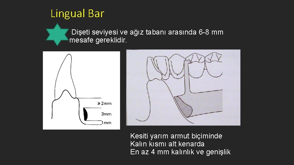 Lingual Bar Dişeti seviyesi ve ağız tabanı arasında 6 -8 mm mesafe gereklidir. Kesiti