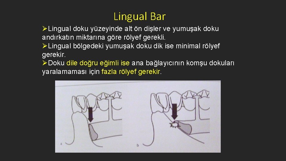 Lingual Bar ØLingual doku yüzeyinde alt ön dişler ve yumuşak doku andırkatın miktarına göre
