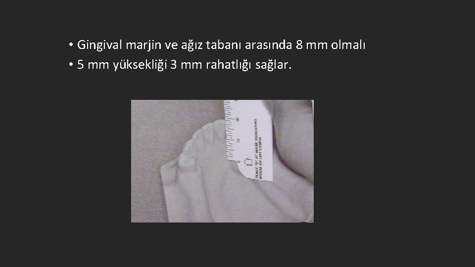  • Gingival marjin ve ağız tabanı arasında 8 mm olmalı • 5 mm