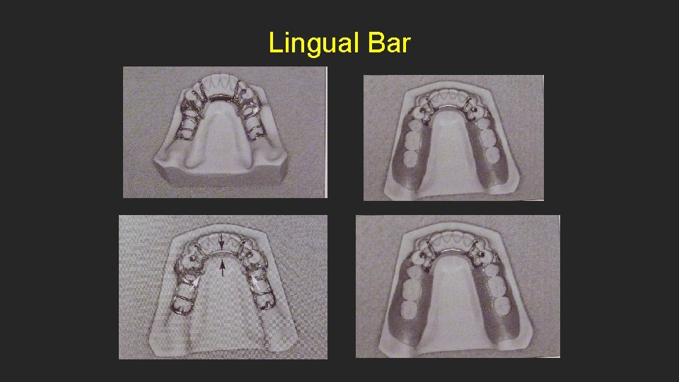 Lingual Bar 
