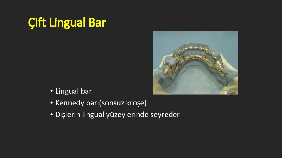 Çift Lingual Bar • Lingual bar • Kennedy barı(sonsuz kroşe) • Dişlerin lingual yüzeylerinde