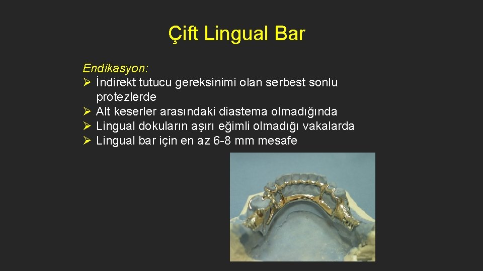 Çift Lingual Bar Endikasyon: Ø İndirekt tutucu gereksinimi olan serbest sonlu protezlerde Ø Alt