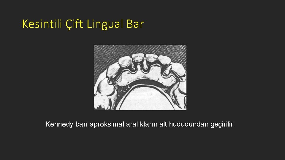 Kesintili Çift Lingual Bar Kennedy barı aproksimal aralıkların alt hududundan geçirilir. 