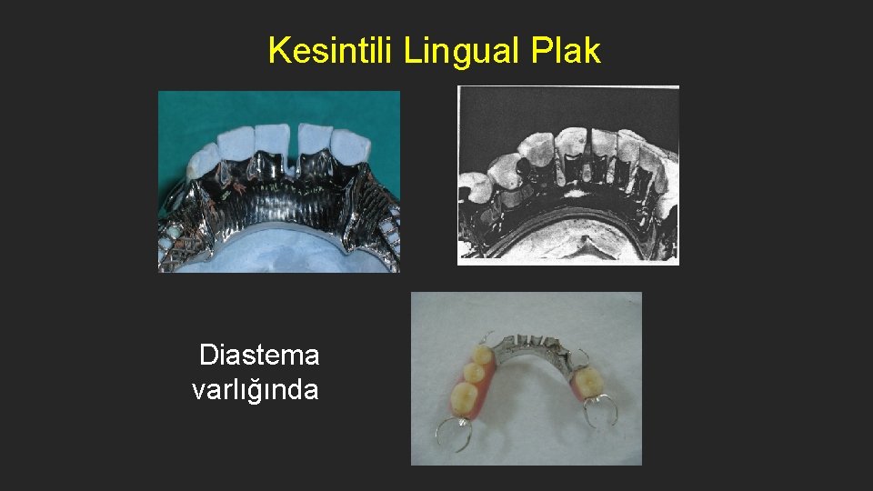 Kesintili Lingual Plak Diastema varlığında 