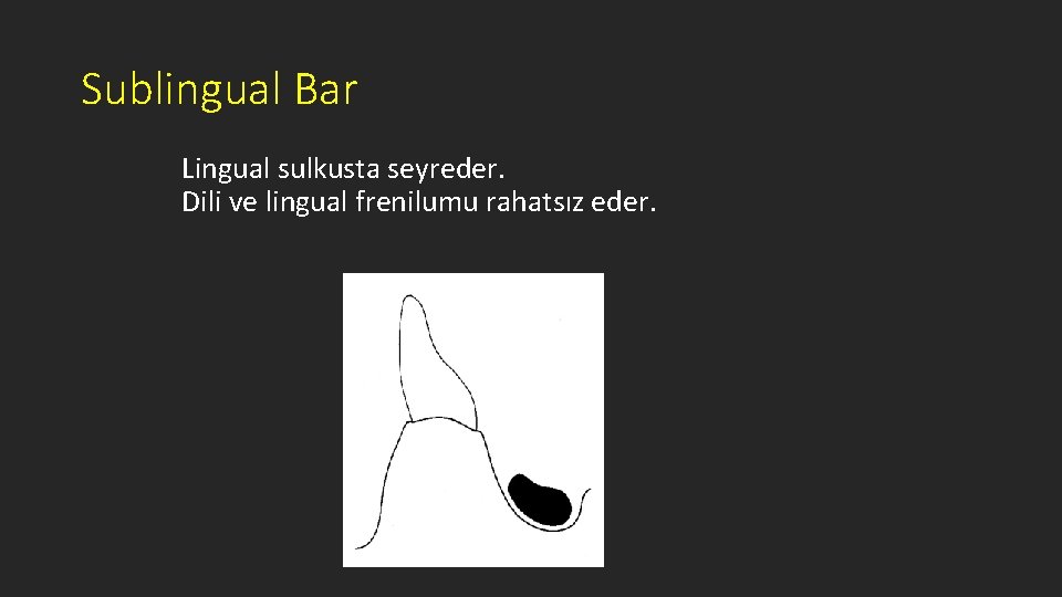 Sublingual Bar Lingual sulkusta seyreder. Dili ve lingual frenilumu rahatsız eder. 