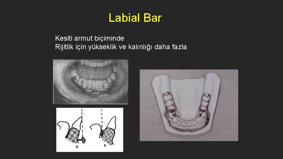 Labial Bar Kesiti armut biçiminde Rijitlik için yükseklik ve kalınlığı daha fazla 