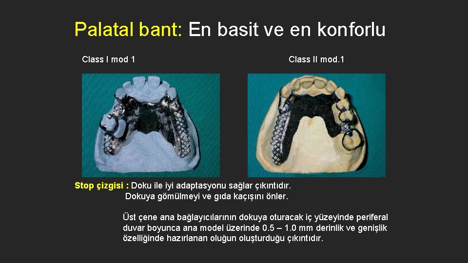 Palatal bant: En basit ve en konforlu Class I mod 1 Class II mod.