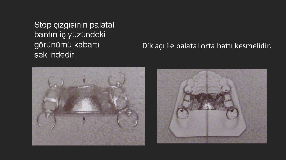 Stop çizgisinin palatal bantın iç yüzündeki görünümü kabartı şeklindedir. Dik açı ile palatal orta