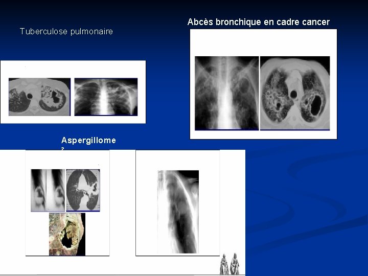 Tuberculose pulmonaire Aspergillome ² Abcès bronchique en cadre cancer 