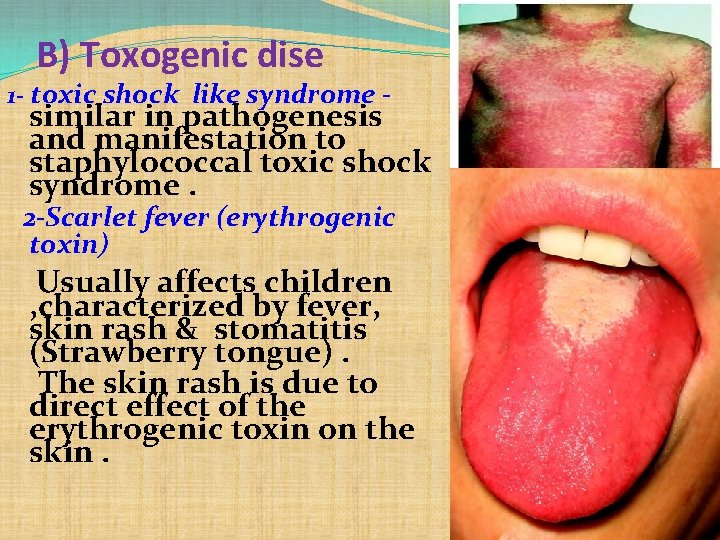 B) Toxogenic dise 1 - toxic shock like syndrome - similar in pathogenesis and