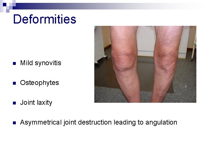 Deformities n Mild synovitis n Osteophytes n Joint laxity n Asymmetrical joint destruction leading