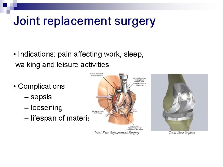 Joint replacement surgery • Indications: pain affecting work, sleep, walking and leisure activities •