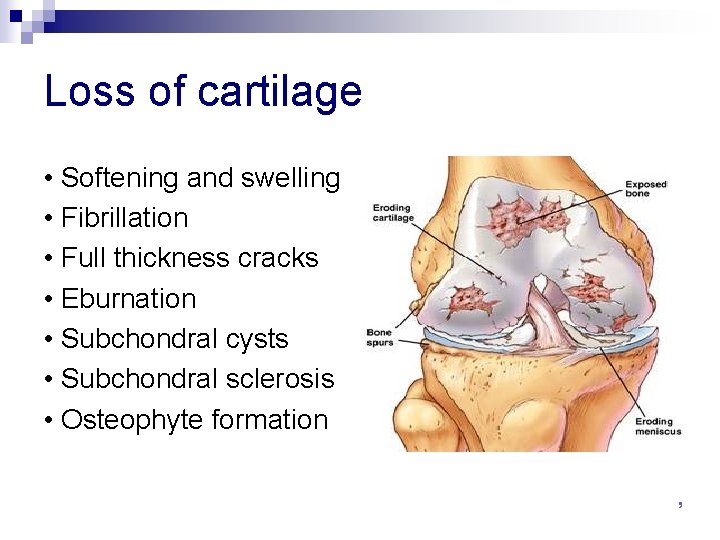 Loss of cartilage • Softening and swelling • Fibrillation • Full thickness cracks •