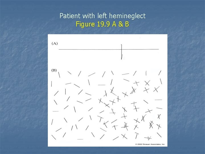 Patient with left hemineglect Figure 19. 9 A & B 