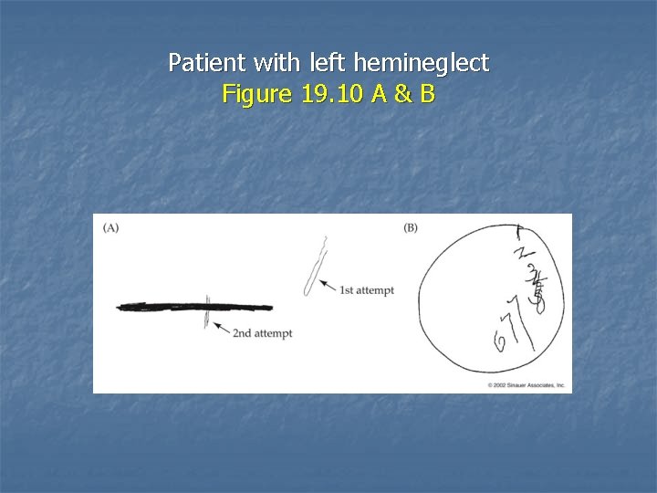 Patient with left hemineglect Figure 19. 10 A & B 