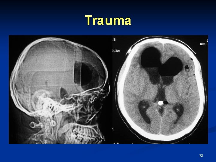 Trauma 23 