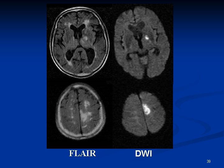 FLAIR DWI 39 
