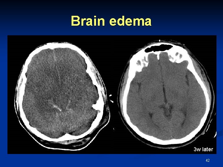 Brain edema 3 w later 42 