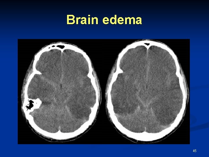 Brain edema 45 